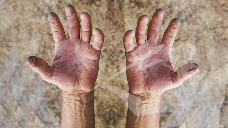 Mani secche e screpolate: cause e rimedi