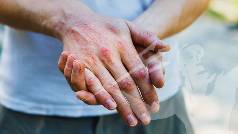 Dermatite da contatto mani e dita: irritativa o allergica?