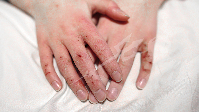 Ragadi mani: cause, rimedi naturali, crema