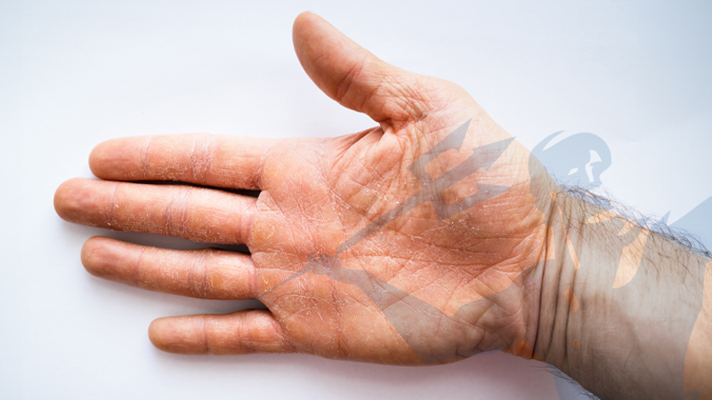 Mani screpolate e spaccate: crema e rimedi estate-inverno